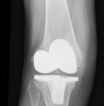 Risico op knieartrose al vroeg te bepalen