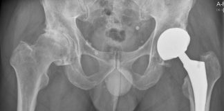 Zorgverzekeraars verhalen hersteloperaties PIP-implantaten op ziekenhuizen