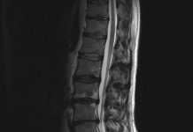 Fixeren met schroeven bij vernauwde wervelkanaal vaak overbodig