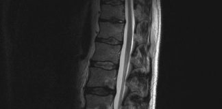 Fixeren met schroeven bij vernauwde wervelkanaal vaak overbodig