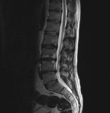 Fixeren met schroeven bij vernauwde wervelkanaal vaak overbodig