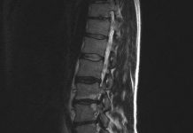 Nieuwe herniabehandeling (PTED) voorlopig vergoed