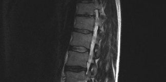 Nieuwe herniabehandeling (PTED) voorlopig vergoed