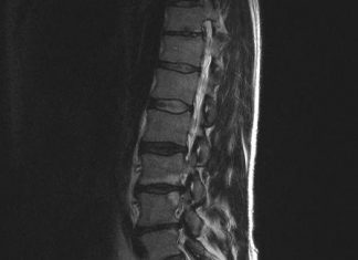 Nieuwe herniabehandeling (PTED) voorlopig vergoed