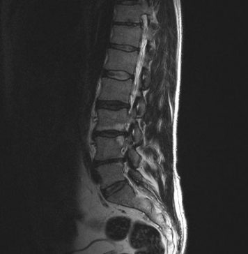 Nieuwe herniabehandeling (PTED) voorlopig vergoed