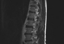 Vaak reuma bij jongere met rugpijn