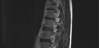 Vaak reuma bij jongere met rugpijn