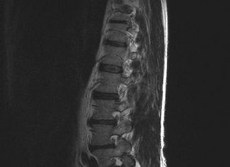 Vaak reuma bij jongere met rugpijn