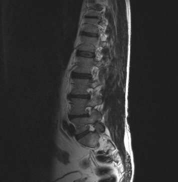 Vaak reuma bij jongere met rugpijn