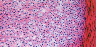 Is PRP de oplossing bij weke delen en kraakbeen letsels? kraakbeen