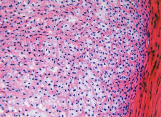 Is PRP de oplossing bij weke delen en kraakbeen letsels? kraakbeen