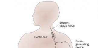 Reumachip onderdrukt artritis N. Vagus stimulator