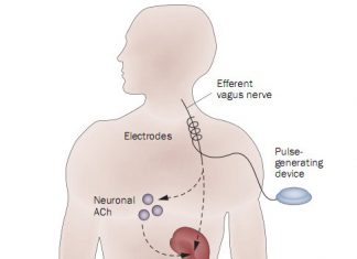 Chip in nek voor reumapatiënten N. Vagus stimulator