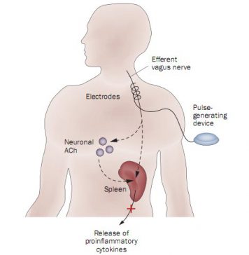 Chip in nek voor reumapatiënten N. Vagus stimulator