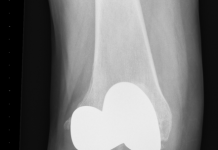 Orthopeden plaatsen 3D-geprinte onderdelen knieprothese
