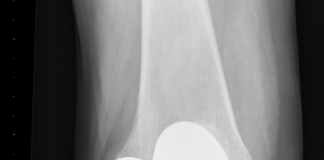 Orthopeden plaatsen 3D-geprinte onderdelen knieprothese