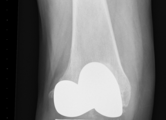 Orthopeden plaatsen 3D-geprinte onderdelen knieprothese