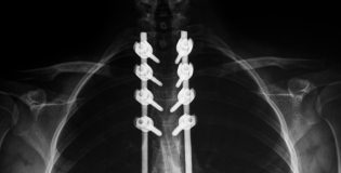 Schade aan wervelkolom bepaald door trillingsanalyse