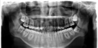 Tandenknarsen en fysiotherapie Kaak