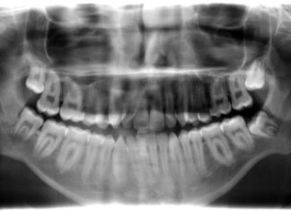 Tandenknarsen en fysiotherapie Kaak