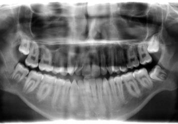 Tandenknarsen en fysiotherapie Kaak