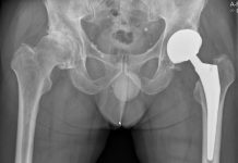 Ingreep heupprothese kan prima poliklinisch