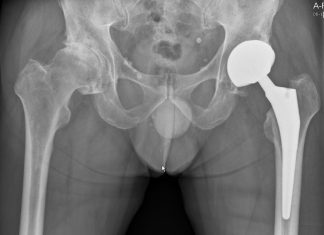 Ingreep heupprothese kan prima poliklinisch