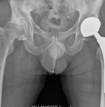 Gebroken heup meer impact dan gedacht