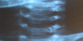 Update: Behandeling chiropractor geen aanleiding wervelfractuur bij baby