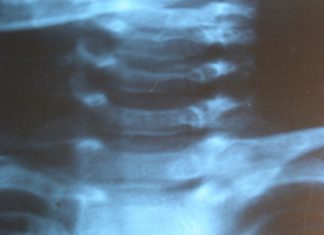 Manuele therapie bij zuigelingen alternatieve behandeling?