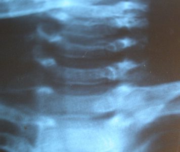 Manuele therapie bij zuigelingen alternatieve behandeling?