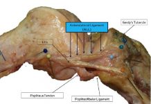 Belgische chirurgen ontdekken anterolateraal ligament in de knie Een foto van een rechterknie na een volledige dissectie van de ALL-gewrichtsband