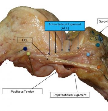 Belgische chirurgen ontdekken anterolateraal ligament in de knie Een foto van een rechterknie na een volledige dissectie van de ALL-gewrichtsband