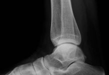 Gezocht: mensen met hielspoorklachten