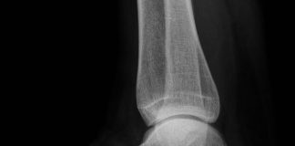 Gezocht: mensen met hielspoorklachten