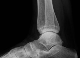 Gezocht: mensen met hielspoorklachten