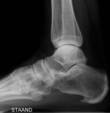 Gezocht: mensen met hielspoorklachten