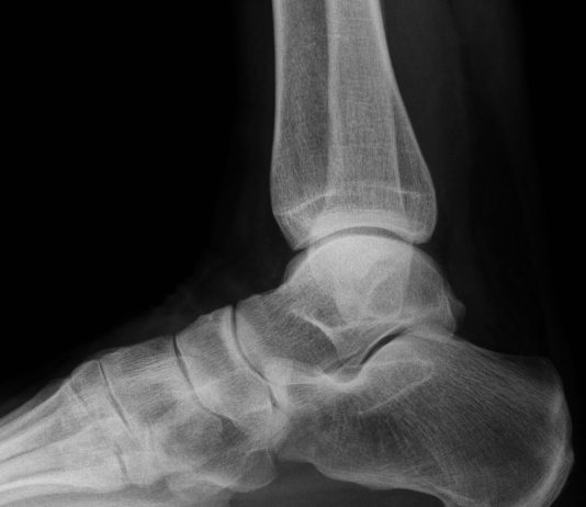 Gezocht: mensen met hielspoorklachten