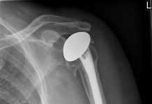 Rijnland Ziekenhuis plaatst eerste schouderprothese uit 3D-printer