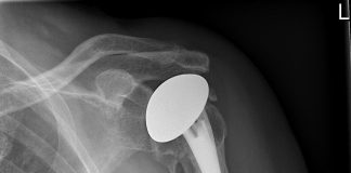 Rijnland Ziekenhuis plaatst eerste schouderprothese uit 3D-printer