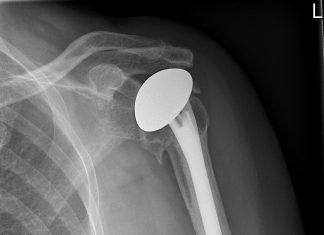 Rijnland Ziekenhuis plaatst eerste schouderprothese uit 3D-printer