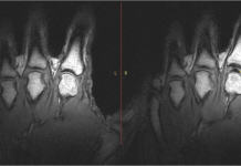 Video: dit gebeurt er als je je vingers knakt