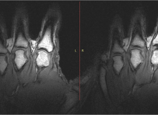 Video: dit gebeurt er als je je vingers knakt