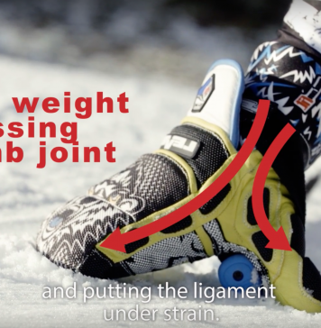 Chirurg bedenkt handschoen tegen ski-duim