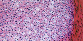 Oorzaak van chronische peesontsteking ontrafeld Peesweefsel