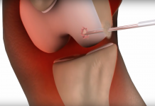 Radiotherapie niet effectief bij gonartrose arthrose pleister