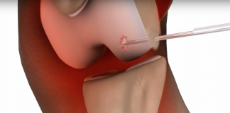 Slecht cholesterol draagt mogelijk bij aan artrose arthrose pleister