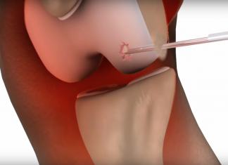 In 2018 bijna 1,5 miljoen mensen met artrose arthrose pleister