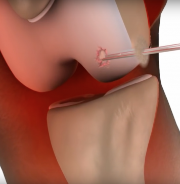 Op zoek naar therapie op maat voor artrose arthrose pleister