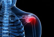 De SNN Praktijkrichtlijn Frozen Shoulder